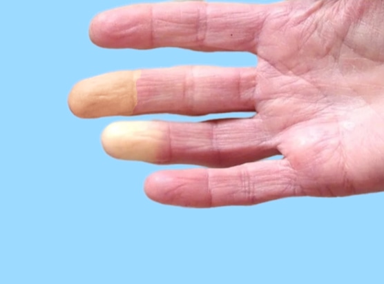 Qué es el Fenómeno Raynaud y cómo detectarlo